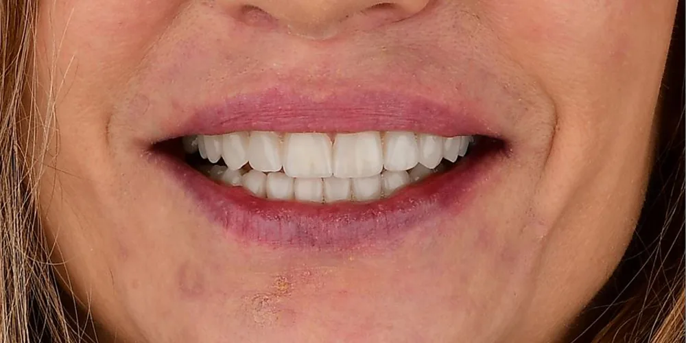 Before & After Gallery: Veneers After 2 of 4
