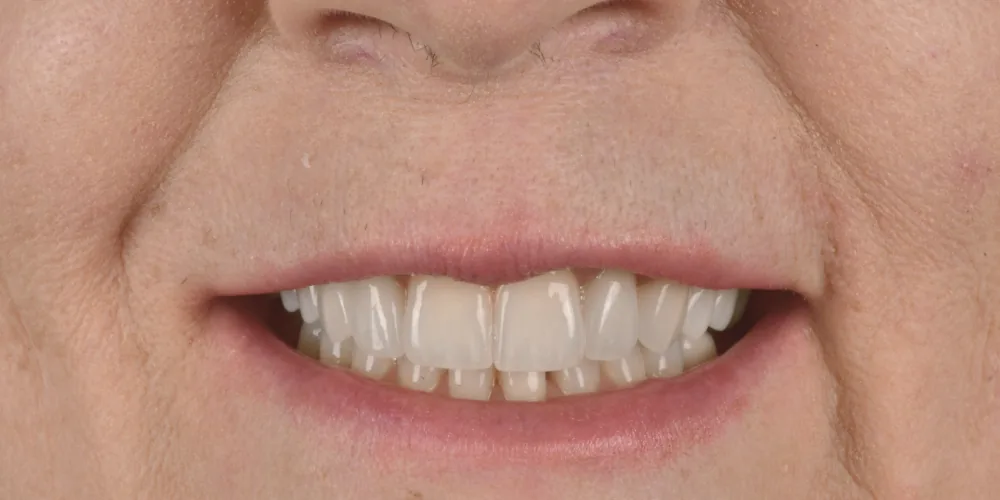 Before & After Gallery: Veneers After 2 of 4