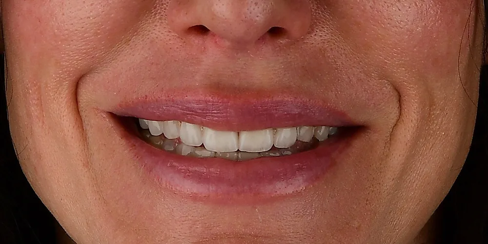 Before & After Gallery: Veneers After 2 of 4