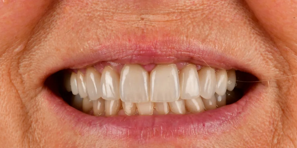 Before & After Gallery: Veneers After 2 of 4