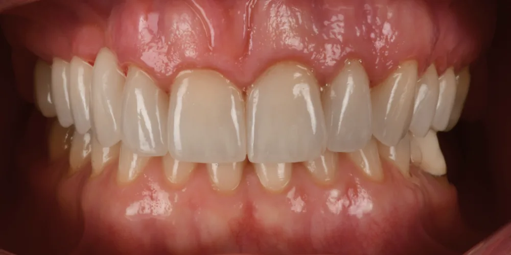 Before & After Gallery: Veneers After 4 of 4