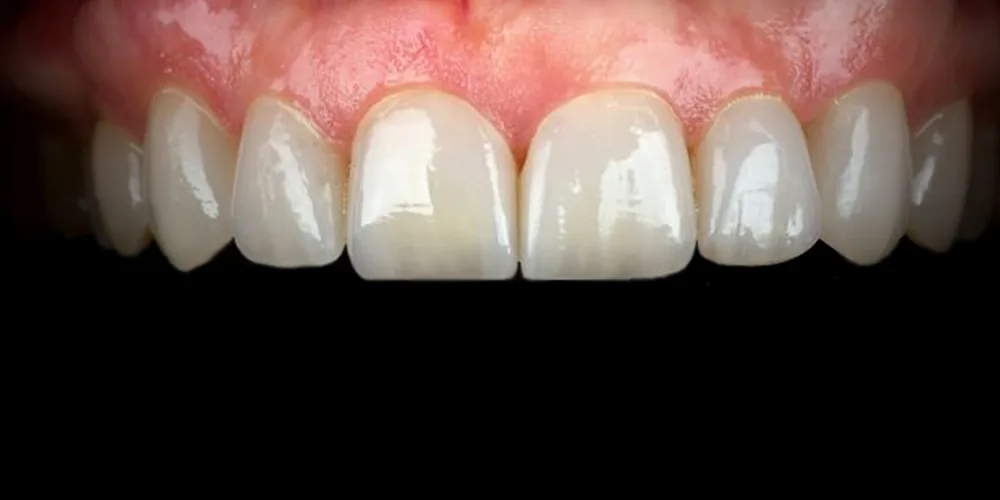Before & After Gallery: Veneers After 4 of 4