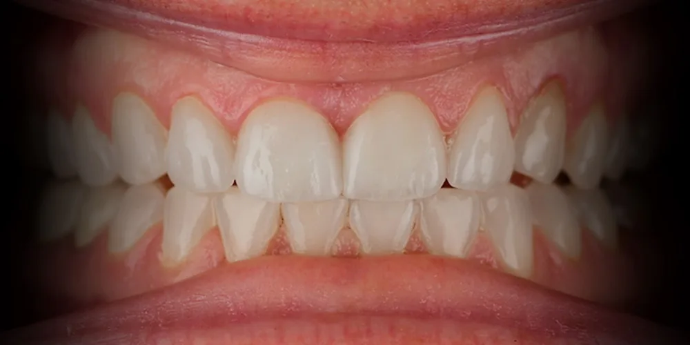 Before & After Gallery: Veneers After 4 of 4