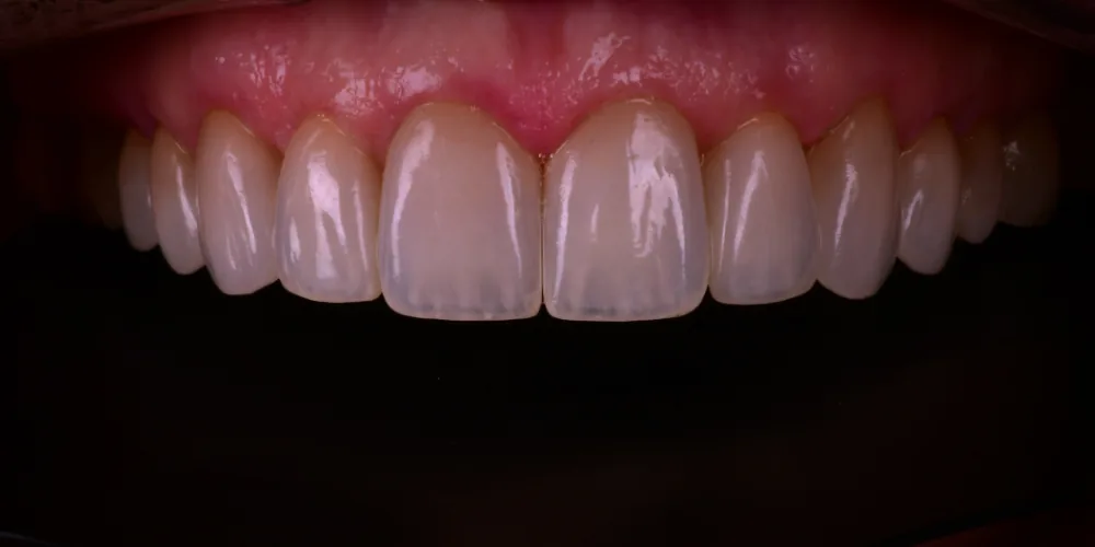 Before & After Gallery: Veneers After 4 of 4