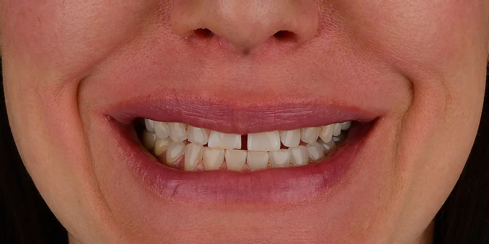 Before & After Gallery: Veneers Before 1 of 4