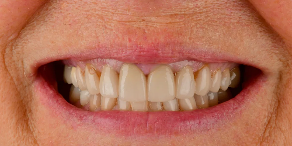 Before & After Gallery: Veneers Before 1 of 4
