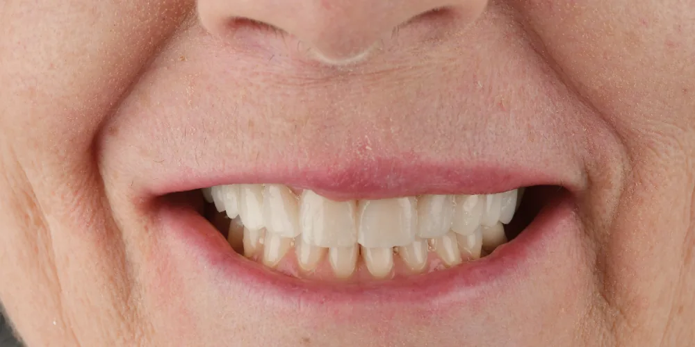 Before & After Gallery: Veneers Before 1 of 4