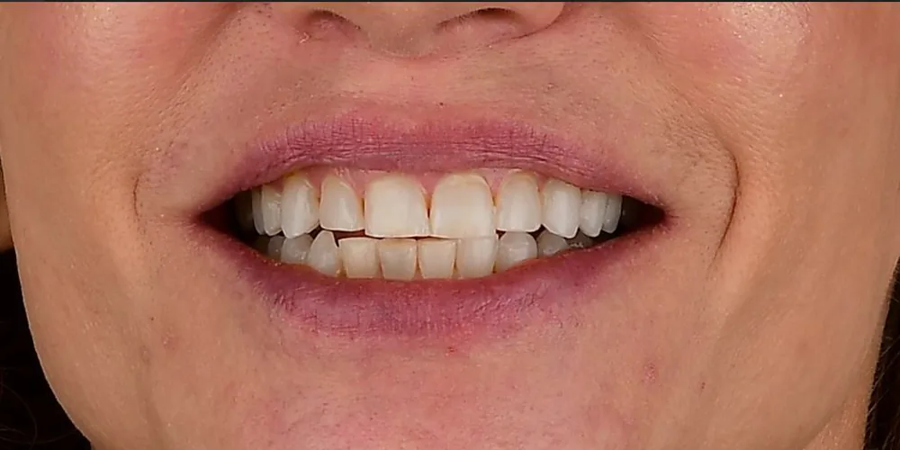 Before & After Gallery: Veneers Before 1 of 4