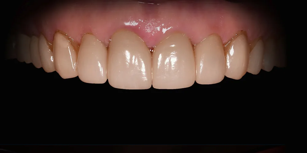 Before & After Gallery: Veneers Before 3 of 4
