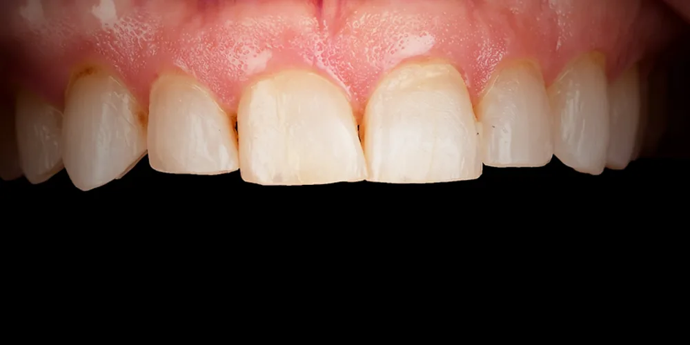 Before & After Gallery: Veneers Before 3 of 4