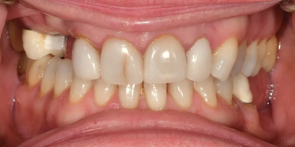 Before & After Gallery: Veneers Before 3 of 4