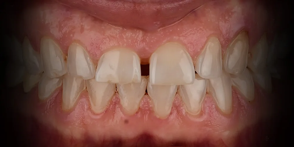 Before & After Gallery: Veneers Before 3 of 4