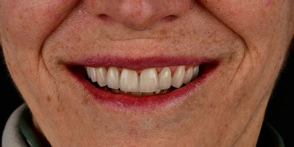 Before & After Gallery: Veneers Redo After 2 of 4