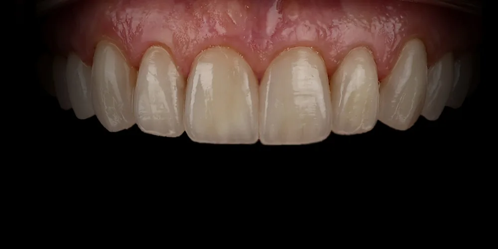 Before & After Gallery: Veneers Redo After 4 of 4
