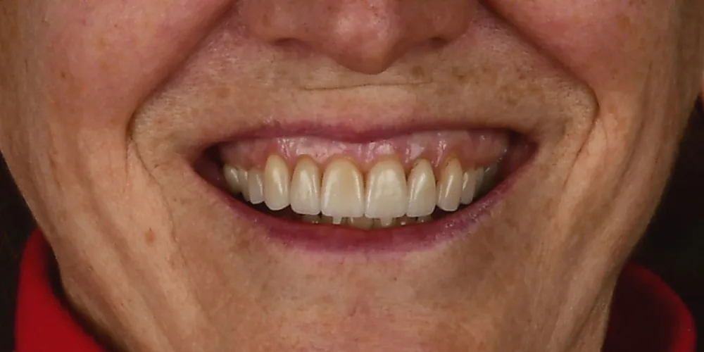 Before & After Gallery: Veneers Redo Before 1 of 4