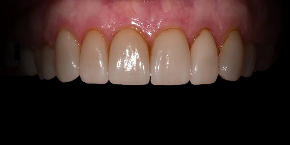 Before & After Gallery: Veneers Redo Before 3 of 4