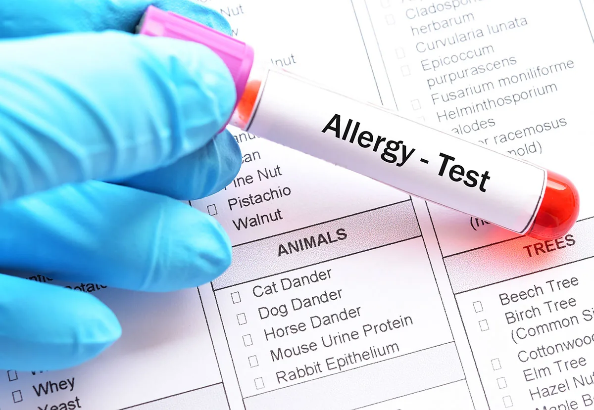 Dental Allergy Testing: Benefits of Testing for Biocompatibility of Dental Materials