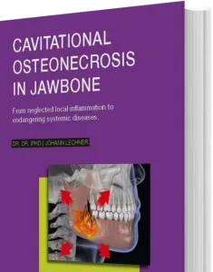Dental Cavitations: Cavitational Osteonecrosis Jawbone