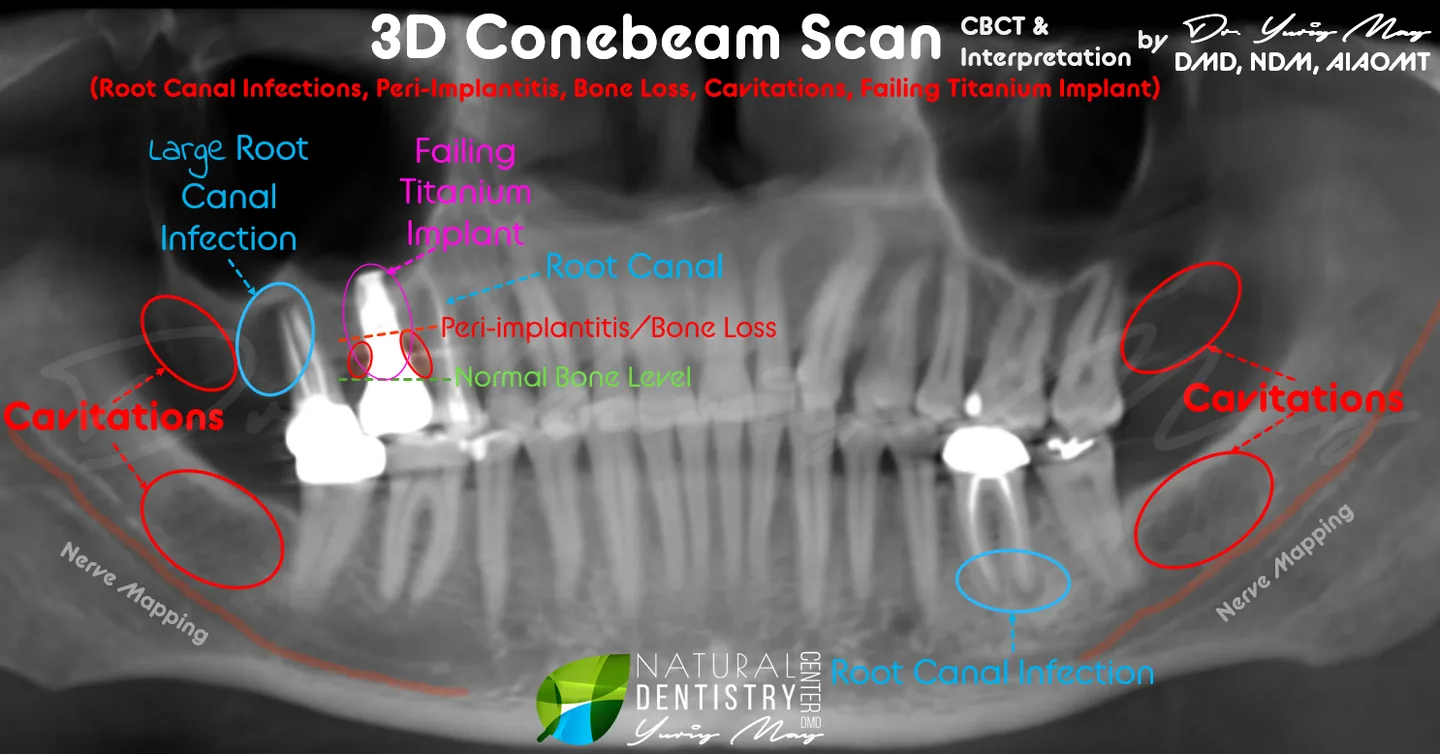 Dental Cavitations: Conebeam 3D Scan Infections