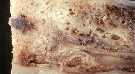 Dental Cavitations: DENTAL2