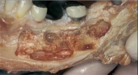 Dental Cavitations: DENTAL3