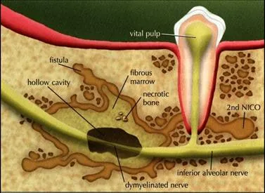 Dental Cavitations: ILLUST1