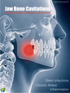 Dental Cavitations: Jaw Bone Cavitations