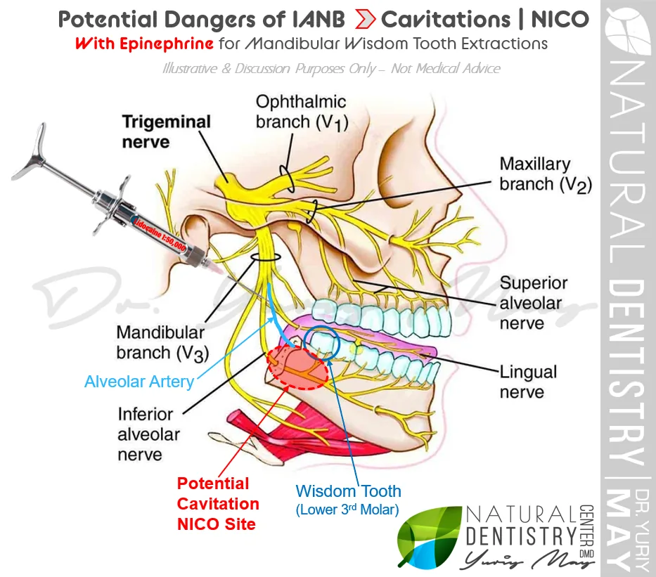 Dental Cavitations: NERVEB1