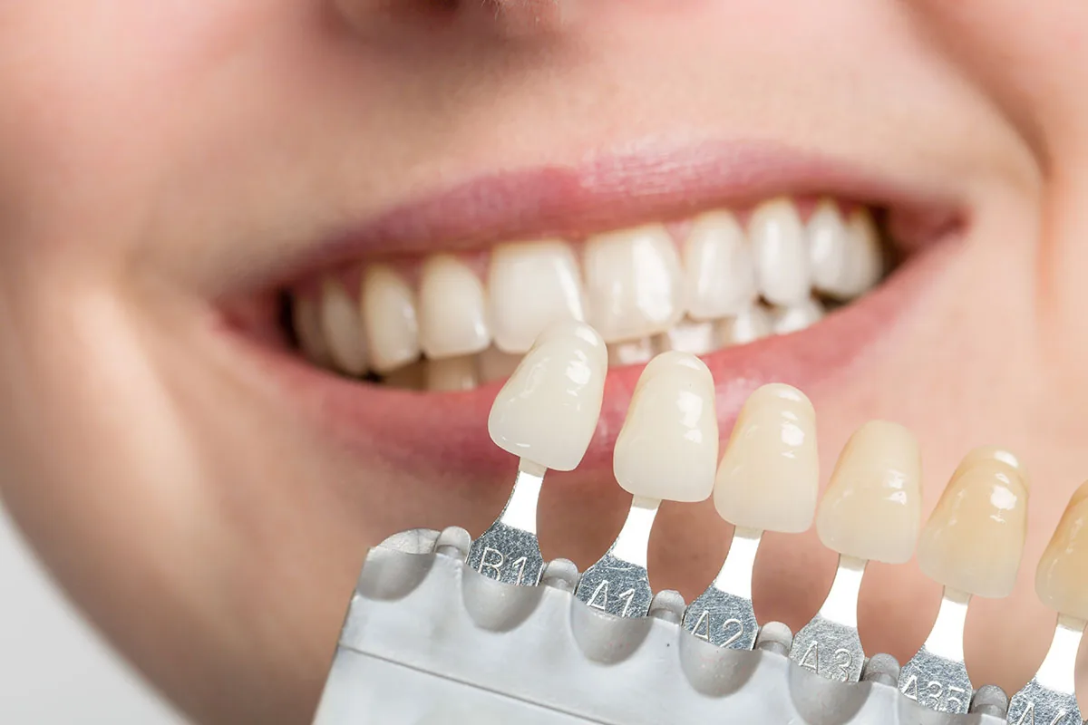 Natural Smile Design: natural smile 1