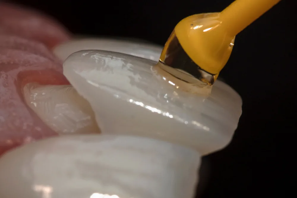 Veneers: image 1 1