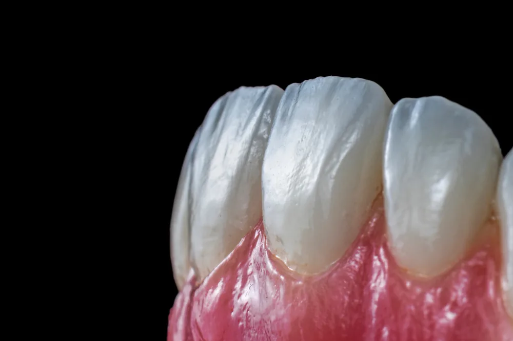 Veneers: image 2 1