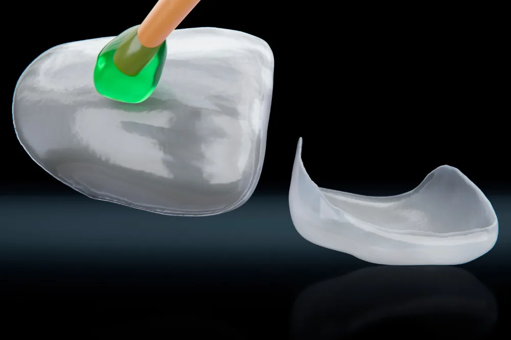 Veneers: image 5 1