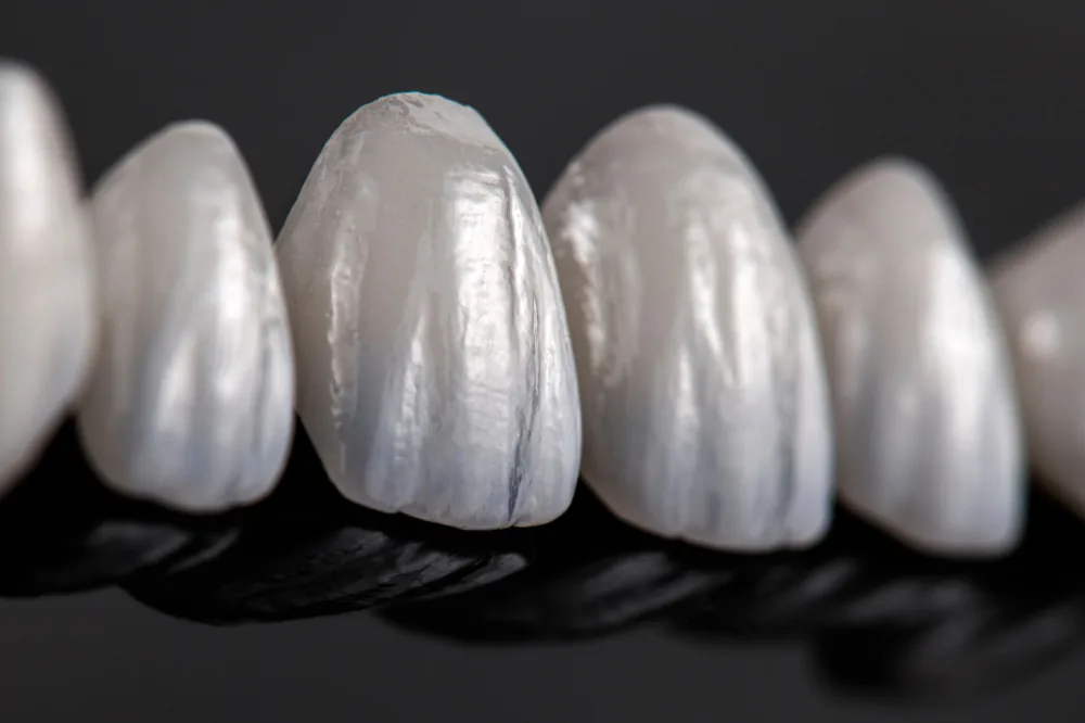 Veneers: image 7 1