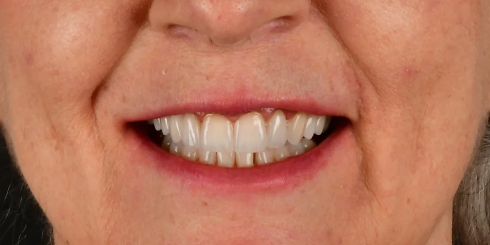 Veneers After 2 of 4