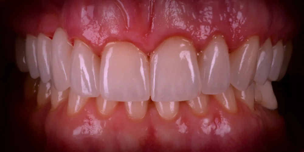 Veneers After 4 of 4