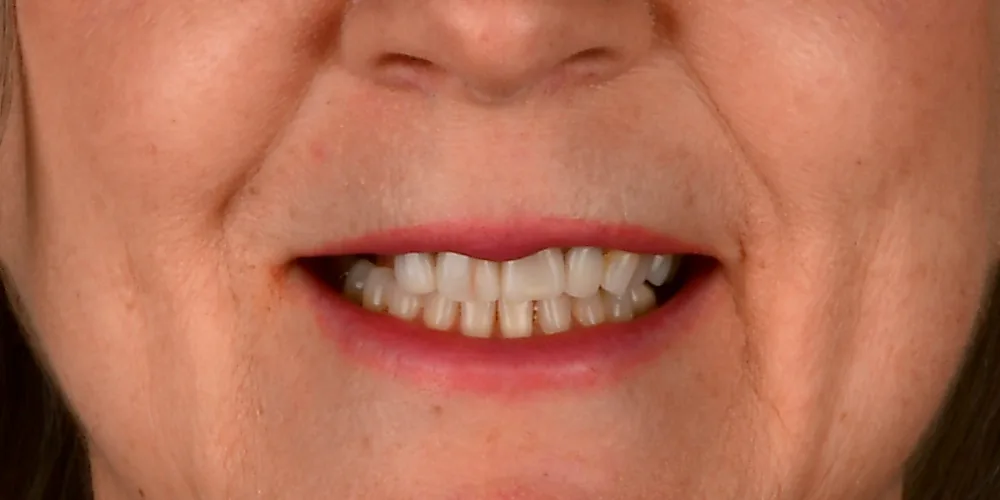 Veneers Before 1 of 4