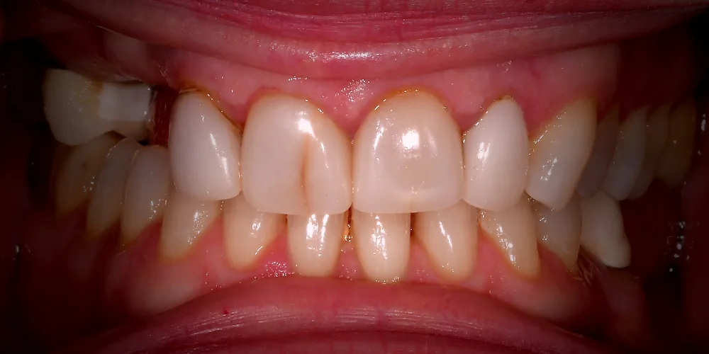 Veneers Before 3 of 4