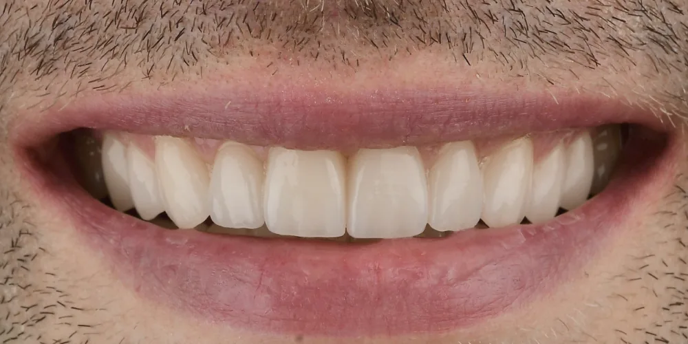 Veneers Re-Do After 2 of 4
