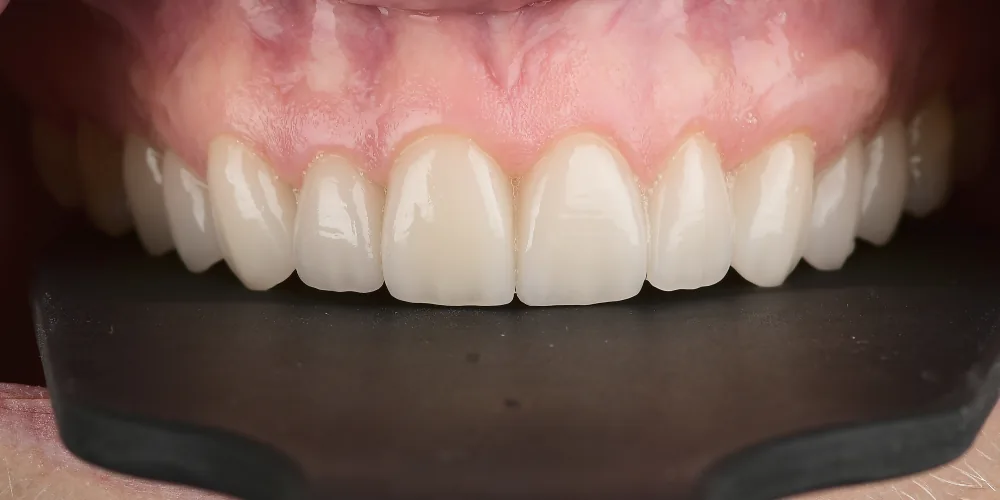 Veneers Re-Do After 4 of 4