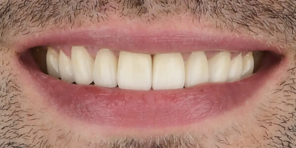 Veneers Re-Do Before 1 of 4