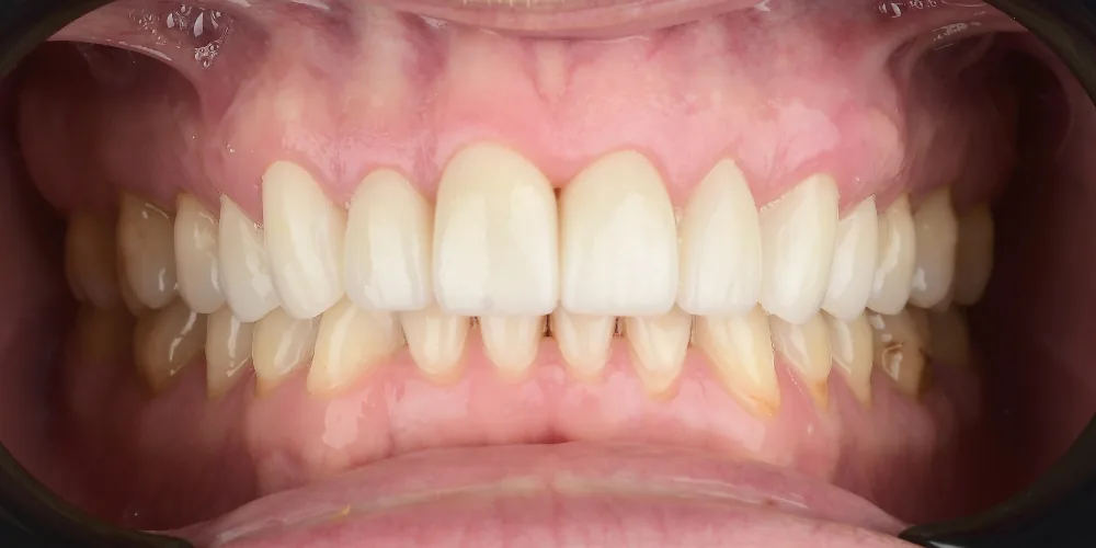 Veneers Re-Do Before 3 of 4